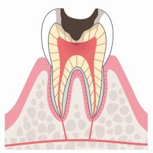 C2（象牙質にまで達したむし歯）