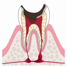 C3（歯の神経に達したむし歯）