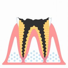 C4（歯のほとんどがむし歯で失われた状態）
