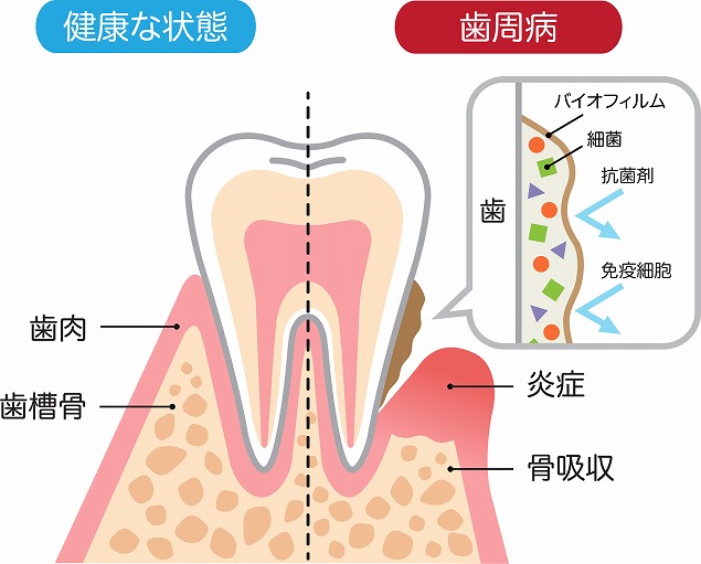 歯周病の症状