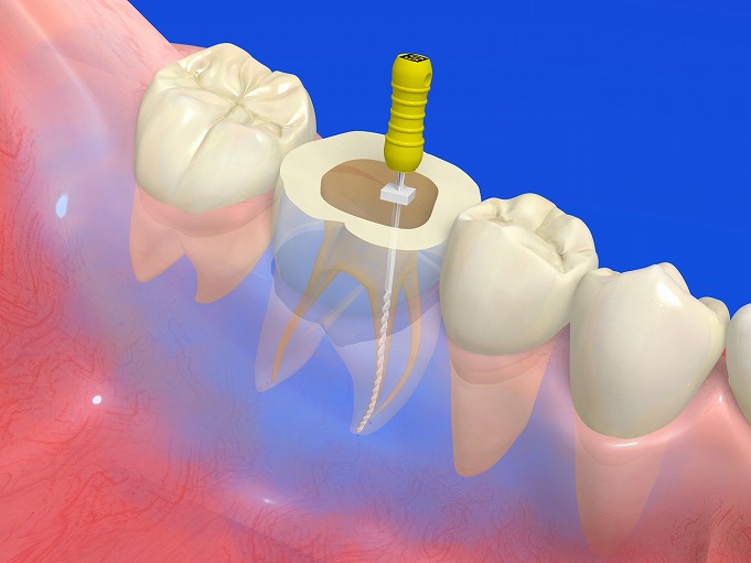根管治療が必要なケース